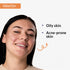 Fixderma Skincare Skarfix-Plus Scar Removal Cream Hyperpigmentation And Melasma Treatment